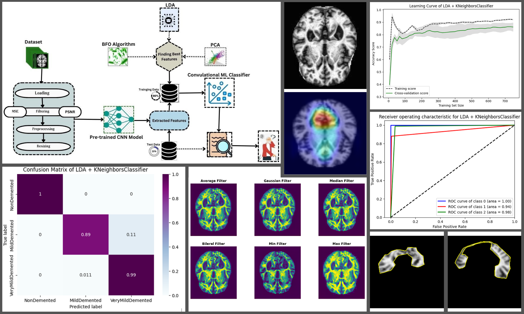 Alzheimer's Disease Detection